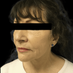 Facelift Before & After Patient #1641