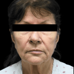 Facelift Before & After Patient #1641