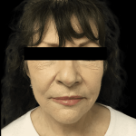 Facelift Before & After Patient #1641