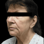 Facelift Before & After Patient #1641