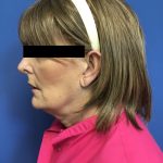 Facelift Before & After Patient #1651