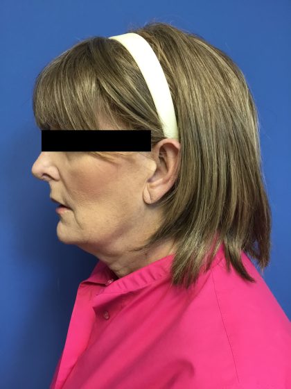 Facelift Before & After Patient #1651