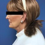 Facelift Before & After Patient #1651