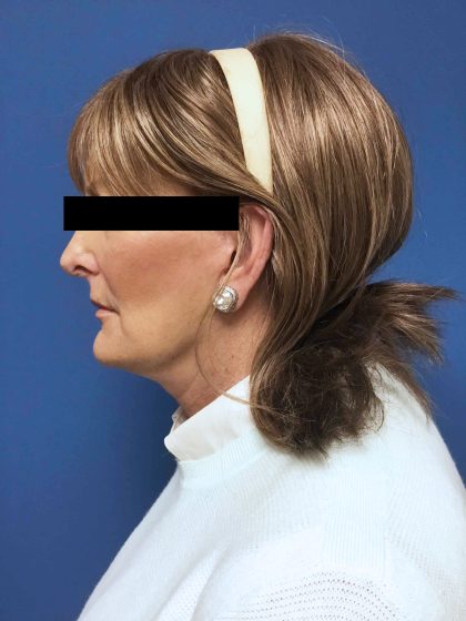 Facelift Before & After Patient #1651
