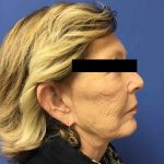 Facelift Before & After Patient #1654