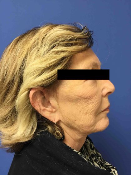 Facelift Before & After Patient #1654