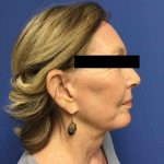 Facelift Before & After Patient #1654