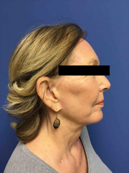 Facelift Before & After Patient #1654