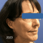 Facelift Before & After Patient #1657