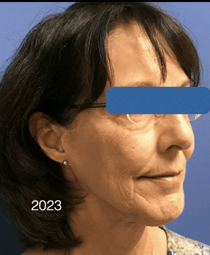 Facelift Before & After Patient #1657