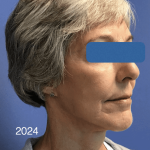 Facelift Before & After Patient #1657