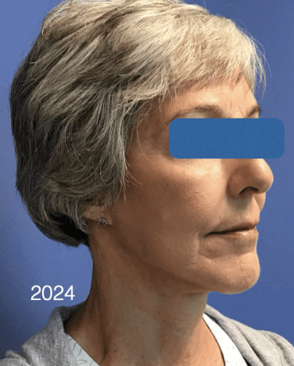Facelift Before & After Patient #1657