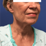 Facelift Before & After Patient #1660