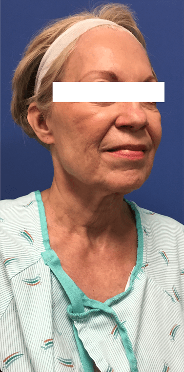Facelift Before & After Patient #1660