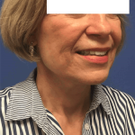 Facelift Before & After Patient #1660