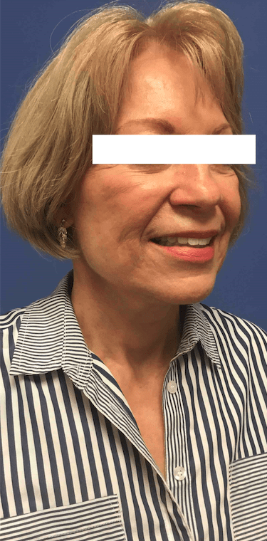 Facelift Before & After Patient #1660