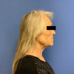 Facelift Before & After Patient #1663