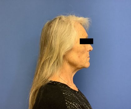 Facelift Before & After Patient #1663