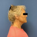 Facelift Before & After Patient #1663