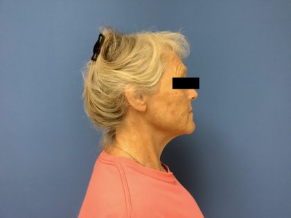 Facelift Before & After Patient #1663