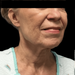Facelift Before & After Patient #1666
