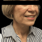 Facelift Before & After Patient #1666