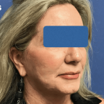 Facelift Before & After Patient #1669
