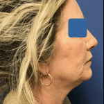 Facelift Before & After Patient #1669