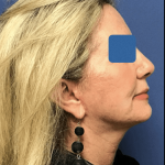 Facelift Before & After Patient #1669