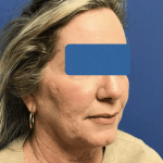 Facelift Before & After Patient #1669