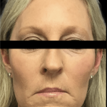 Facelift Before & After Patient #1674