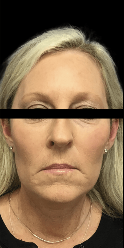 Facelift Before & After Patient #1674