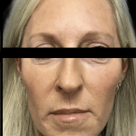 Facelift Before & After Patient #1674