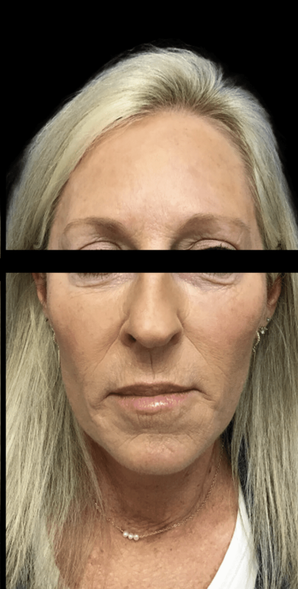 Facelift Before & After Patient #1674
