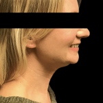 Facelift Before & After Patient #1677