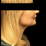Facelift Before & After Patient #1677