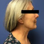 Facelift Before & After Patient #1680
