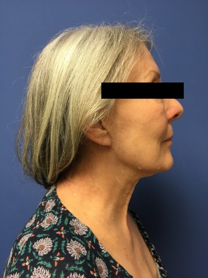 Facelift Before & After Patient #1680