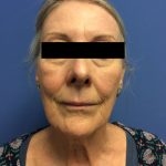 Facelift Before & After Patient #1680