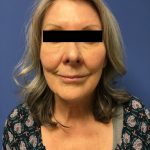 Facelift Before & After Patient #1680
