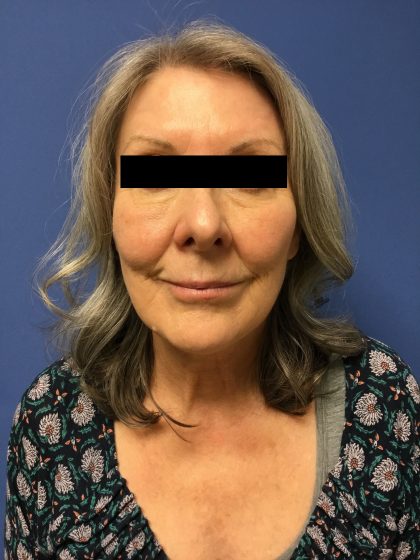 Facelift Before & After Patient #1680