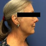 Facelift Before & After Patient #1680