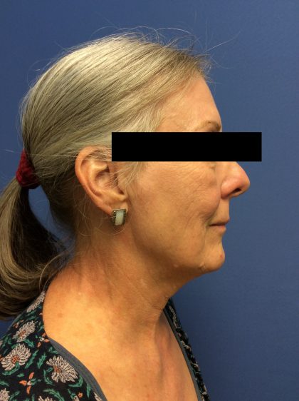 Facelift Before & After Patient #1680