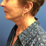 Facelift Before & After Patient #1685