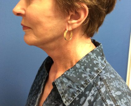 Facelift Before & After Patient #1685