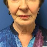 Facelift Before & After Patient #1685