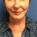 Facelift Before & After Patient #1685
