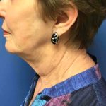 Facelift Before & After Patient #1685