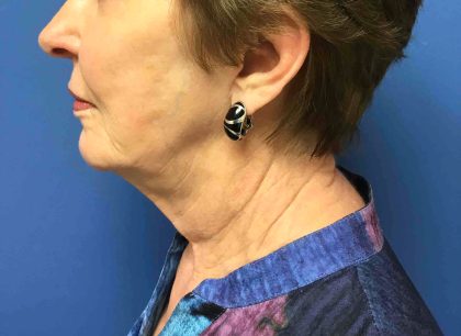 Facelift Before & After Patient #1685