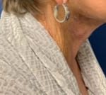 Facelift Before & After Patient #1690